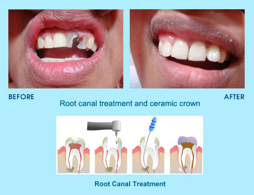 Root Canal Treatment